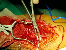 عمل موفقیت‌آمیز پیوند شریان رادیال در بیماران جراحی قلب باز