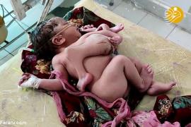 تولد نوزاد دخترهندی با ۴ پا و ۳ دست +عکس