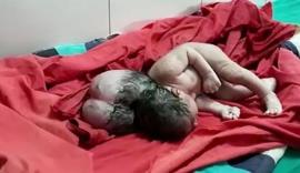 تولد نوزادی با سه سر هند/ عکس