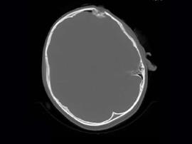 جراحی موفقیت‌آمیز کودک ۱۰ ساله پس از فرو رفتن چوب در سر