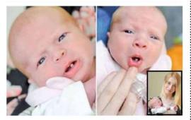 نوزاد دختری که با یک دندان به دنیا آمد+ عکس